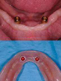 全顎インプラント義歯1術後
